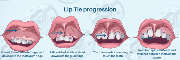 frenectomy for lip tie