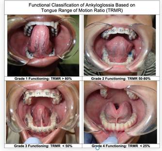 Tongue and lip tie procedure