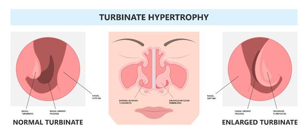 Reasons for snoring nasal turbinates